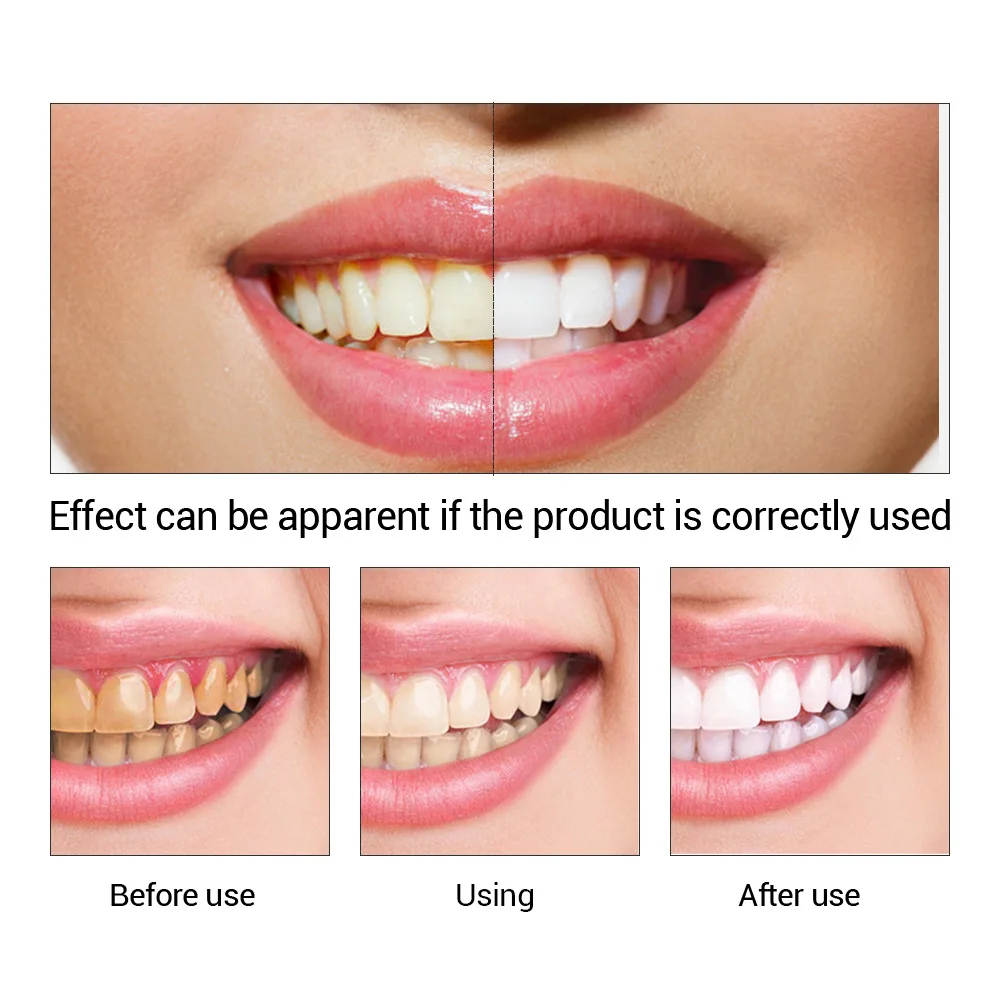 FTEENPLY ฟันไวท์เทนนิ่ง Oral ส - Teeth Whitening Ingredients บทวิจารณ์และราคา