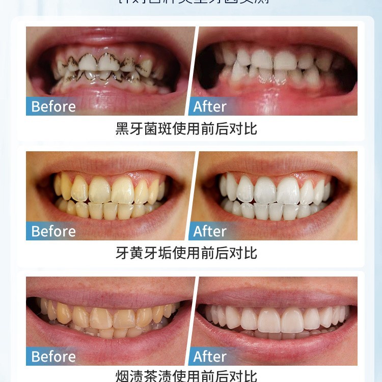 ญี่ปุ่นคู่มือฟันแปรงกําจัดคราบ - Teeth Whitening Japan บทวิจารณ์และราคา