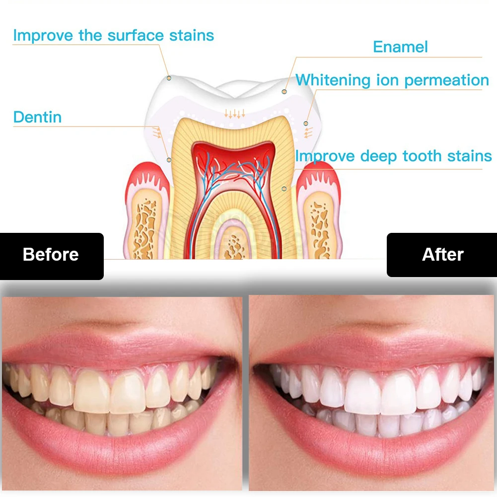 ทันตกรรมชุดฟอกสีฟัน Mini 16 LE - Teeth Whitening Price บทวิจารณ์และราคา
