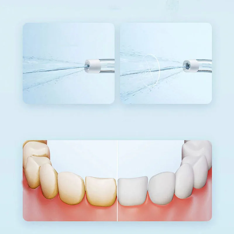 เครื่องฉีดน้ำทำความสะอาดช่องปา - Teeth Whitening Or Tooth Whitening บทวิจารณ์และราคา
